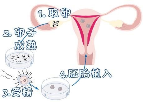 体外受精 IVF-ET